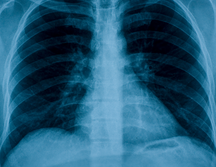 The Effects of Cannabis on the Lungs